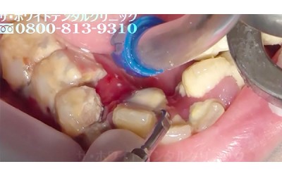 25歲女孩因為害怕看牙醫放任「口腔嚴重石化」  洗牙影片一出..網友：療癒度破表