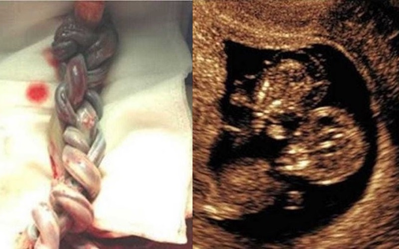 女子肚裡懷有一對臍帶嚴重打結的雙胞胎，生下來後醫生看了直呼「奇蹟」…