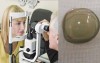 女子去看眼科，被醫生發現她的眼睛裡居然有「17片隱形眼鏡」：從沒有過這種案例！