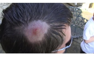 男子從國外回來發現頭上腫了一塊以為是「痘痘」…沒想到用力一擠竟噴出爆噁蟲蟲  （影）