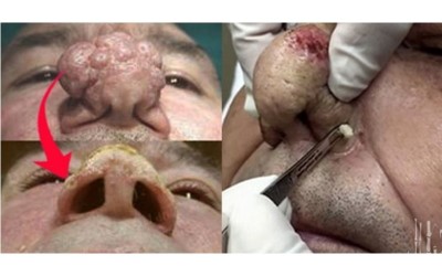 整個鼻子都是痘痘   最後醫師幫他擠出這一大顆...