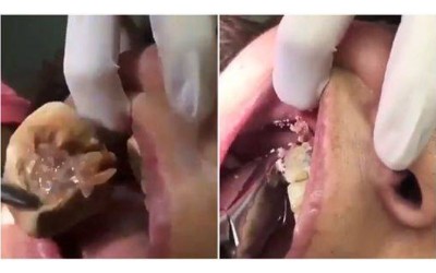女子洗牙醫生竟夾出「巨大噁黃結石」網友驚：到底多久沒刷牙？
